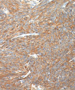 GIST stained with DOG1 antibody
