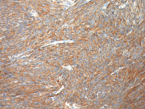 GIST stained with DOG1 antibody
