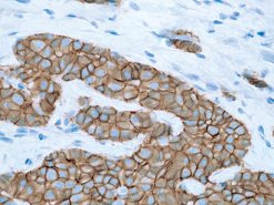 Breast cancer stained with E-cadherin mouse antibody