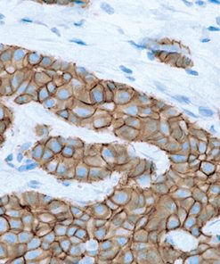 Breast cancer stained with E-cadherin mouse antibody