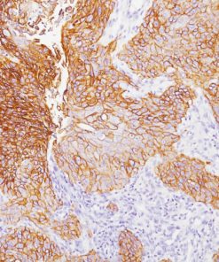 Lung cancer stained with Epidermal Growth Factor Receptor antibody