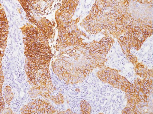 Lung cancer stained with Epidermal Growth Factor Receptor antibody