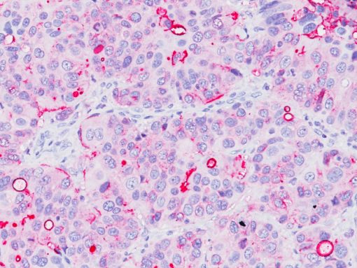 Breast cancer stained with Epithelial Membrane Antigen antibody