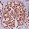 Breast cancer stained with Estrogen-Receptor-ER-Antibody [6F11 + SP1]
