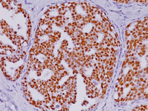 Breast cancer stained with Estrogen-Receptor-ER-Antibody [6F11 + SP1]