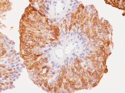 Urothelial carcinoma stained with Uroplakin II + Uroplakin III antibody
