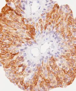Urothelial carcinoma stained with Uroplakin II + Uroplakin III antibody