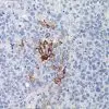 Breast cancer stained with Gross Cystic Disease Fluid Protein-15 Antibody