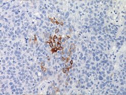 Breast cancer stained with Gross Cystic Disease Fluid Protein-15 Antibody