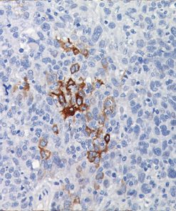 Breast cancer stained with Gross Cystic Disease Fluid Protein-15 Antibody