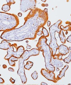 Placenta stained with Human Chorionic Gonadotropin antibody (beta)