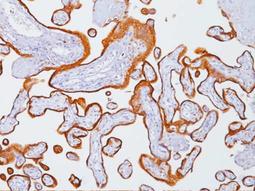 Placenta stained with Human Chorionic Gonadotropin antibody (beta)