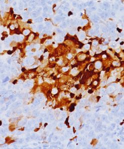 Breast cancer stained with HIF-1 alpha antibody