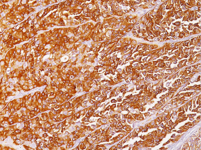 Melanoma stained with HMB45 Antibody