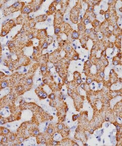Liver cancer stained with Hepatocyte Specific Antigen Antibody (HSA)