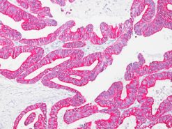Colon cancer stained with Pan Cytokeratin [Lu-5] antibody