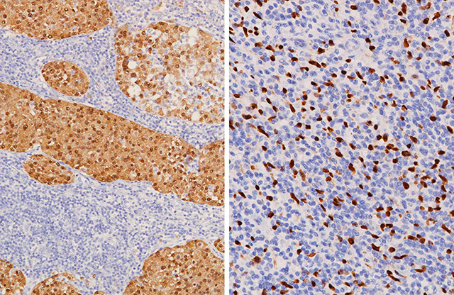 melanoma stained with MART-1 + Tyrosinase and SOX10