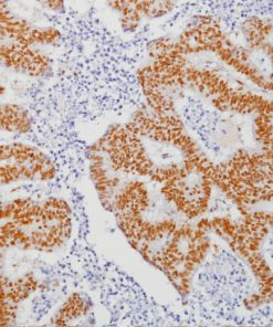 Colon cancer stained with MLH-1 Antibody