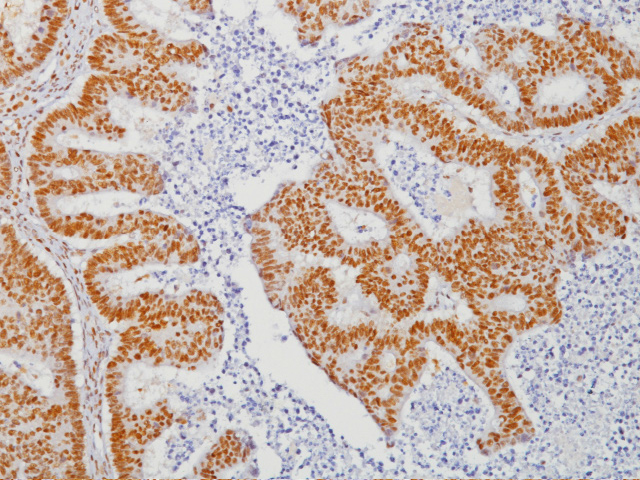 Colon cancer stained with MLH-1 Antibody