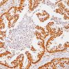 Colon cancer stained with MSH2 antibody