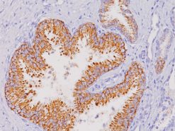 Prostate cancer stained with P504S (P) antibody