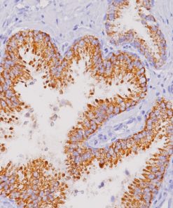 Prostate cancer stained with P504S (P) antibody