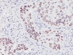 Lung SqCC stained with p40 (P) antibody