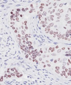 Lung SqCC stained with p40 (P) antibody
