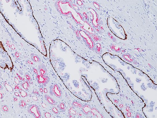 Biocare Medical Awarded Patent for PIN-4™ (CK5/14 + P63 + P504S ...