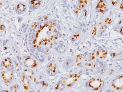 Breast cancer stained with Progesterone Receptor antibody (PR) [16]