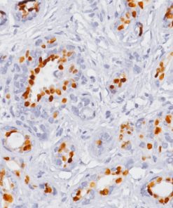 Breast cancer stained with Progesterone Receptor antibody (PR) [16]