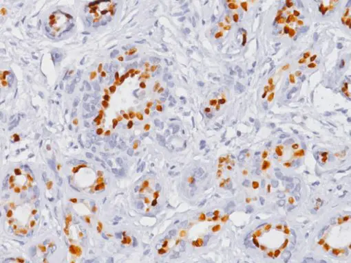 Breast cancer stained with Progesterone Receptor antibody (PR) [16]