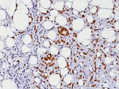 Breast cancer stained with Progesterone Receptor [PgR636] antibody