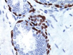 Prostate cancer stained with p63 [4a4] antibody, 2X
