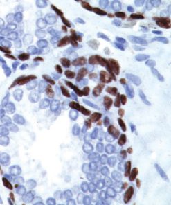 Prostate cancer stained with p63 [4a4] antibody, 2X