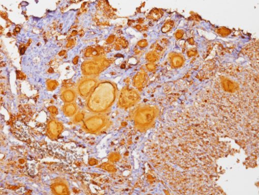 Thyroid cancer stained with Thyroglobulin antibody Cocktail