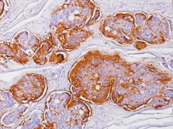 Breast cancer stained with Tumor Associated Glycoprotein antibody [B72.3]